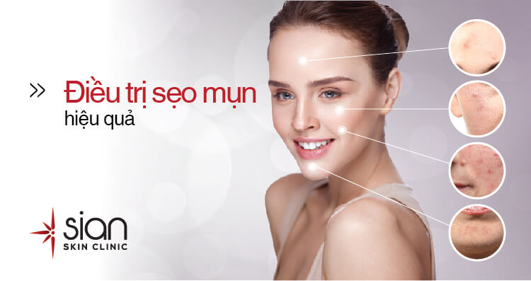điều trị sẹo mụn hiệu quả tại Sian Clinic