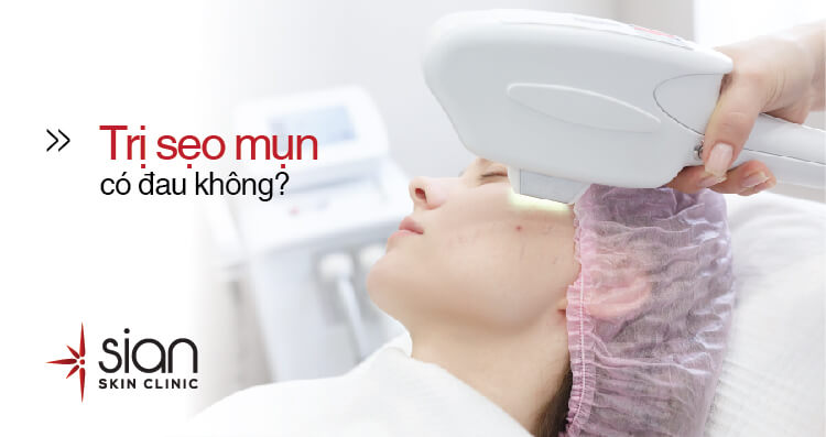 Trị Sẹo Mụn Bằng Công Nghệ Laser CO2 Fractional