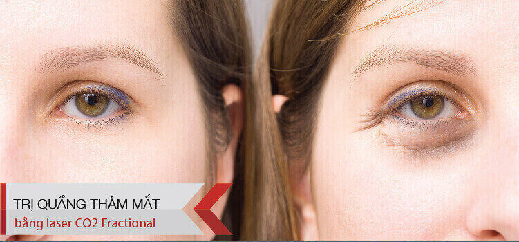 Thẩm mỹ SIAN điều trị quầng thâm mắt