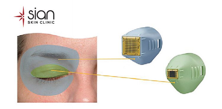 Công nghệ xóa nhăn vùng mắt tại SIAN