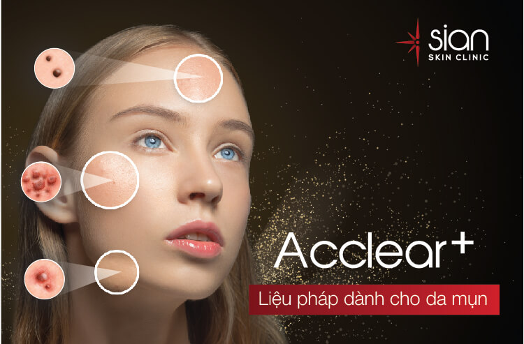 trị mụn viêm sian