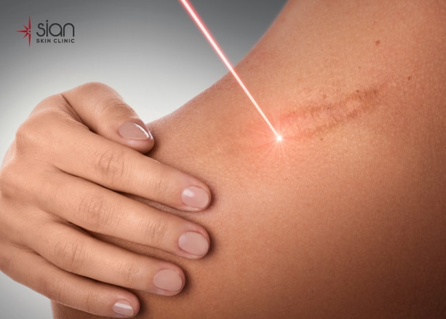 Xóa sẹo bằng Laser Fractional CO2