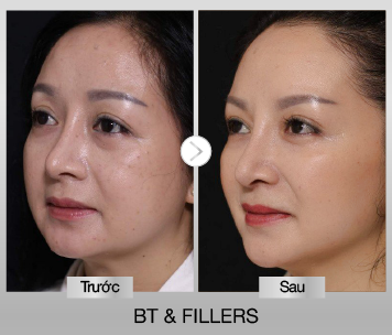 BF AT BT&FILLERS