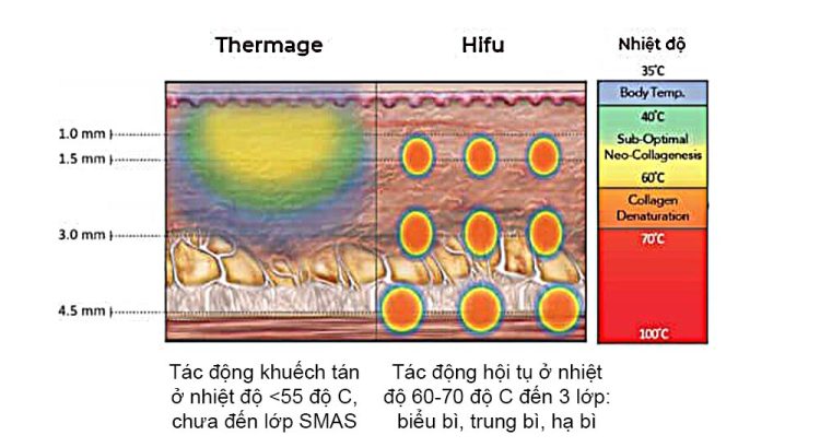 Sự khác biệt giữa công nghệ Thermage và HIFU trên các lớp da