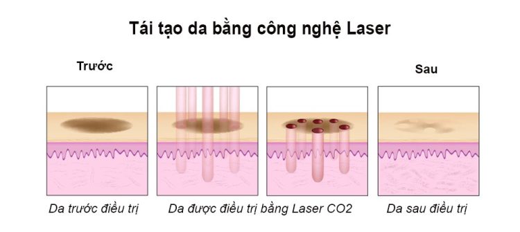 Cách thức hoạt động của công nghệ Laser CO2