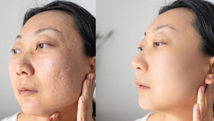 Khách hàng điều trị sẹo rỗ bằng phương pháp Laser Fractional CO2 tại phòng khám SIAN