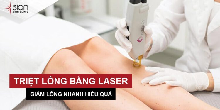 Triệt lông bằng Laser Candela giảm lông nhanh an toàn - hiệu quả cao