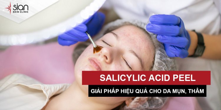 Salicylic Acid peel - Trị mụn lưng và thâm mụn hiệu quả