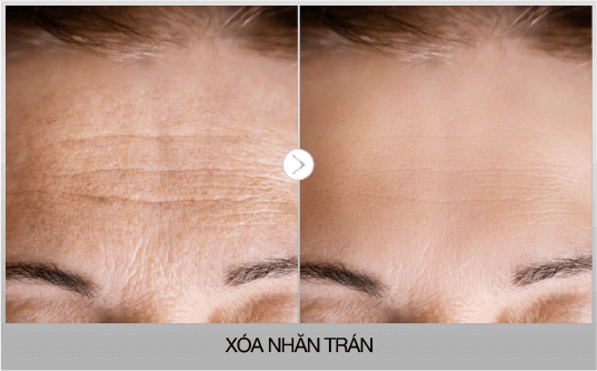 xoa-nep-nhan-tran-voi-ultherapy-prime-tai-phong-kham-sian